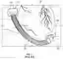 Fig. 02 - VASCULAR GRAFT PROTECTOR