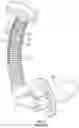 Fig. 03 - VASCULAR GRAFT PROTECTOR