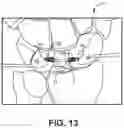 Fig. 13 - Bone Anchor and Related Devices, Systems, and Methods