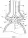 Fig. 07 - Valve prostheses having an integral centering mechanism and methods of use thereof