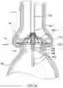 Fig. 14 - Valve prostheses having an integral centering mechanism and methods of use thereof