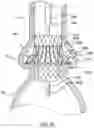 Fig. 15 - Valve prostheses having an integral centering mechanism and methods of use thereof