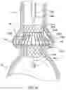 Fig. 16 - Valve prostheses having an integral centering mechanism and methods of use thereof