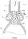 Fig. 22 - Valve prostheses having an integral centering mechanism and methods of use thereof