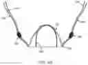 Fig. 11 - Prosthetic mitral valve and delivery method