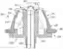 Fig. 01 - Pre-constricted prosthetic heart valves