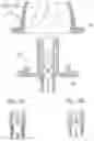 Fig. 04 - Pre-constricted prosthetic heart valves