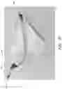 Fig. 14 - Device, system, and method for transcatheter treatment of valve regurgitation