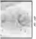 Fig. 32 - Device, system, and method for transcatheter treatment of valve regurgitation