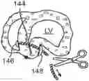 Fig. 01 - Location, time, and/or pressure determining devices, systems, and methods for deployment of lesion-excluding heart implants for treatment of cardiac heart failure and other disease states