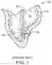 Fig. 02 - Location, time, and/or pressure determining devices, systems, and methods for deployment of lesion-excluding heart implants for treatment of cardiac heart failure and other disease states