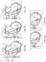 Fig. 05 - Location, time, and/or pressure determining devices, systems, and methods for deployment of lesion-excluding heart implants for treatment of cardiac heart failure and other disease states
