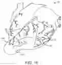Fig. 14 - Location, time, and/or pressure determining devices, systems, and methods for deployment of lesion-excluding heart implants for treatment of cardiac heart failure and other disease states