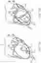 Fig. 15 - Location, time, and/or pressure determining devices, systems, and methods for deployment of lesion-excluding heart implants for treatment of cardiac heart failure and other disease states