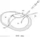 Fig. 17 - Location, time, and/or pressure determining devices, systems, and methods for deployment of lesion-excluding heart implants for treatment of cardiac heart failure and other disease states