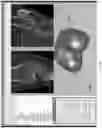Fig. 13 - Kinematic and parameterized modeling for patient-adapted implants, tools, and surgical procedures