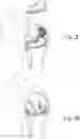 Fig. 08 - Method Of Designing Orthopedic Impants Using In Vivo