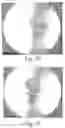 Fig. 22 - Method Of Designing Orthopedic Impants Using In Vivo