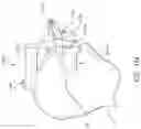 Fig. 24 - Patient specific stemless prosthesis anchor components