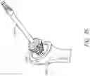 Fig. 28 - Patient specific stemless prosthesis anchor components
