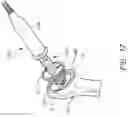 Fig. 29 - Patient specific stemless prosthesis anchor components