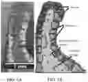 Fig. 02 - Artificial tessellated implants, and systems and methods of making and using same