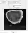 Fig. 13 - Artificial tessellated implants, and systems and methods of making and using same