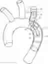 Fig. 01 - Intraluminal vessel prosthesis system