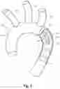 Fig. 03 - Intraluminal vessel prosthesis system