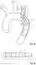 Fig. 04 - Intraluminal vessel prosthesis system