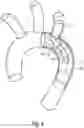 Fig. 05 - Intraluminal vessel prosthesis system