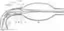 Fig. 01 - BALLOON ASSISTED ENDOLUMINAL PROSTHESIS DEPLOYMENT