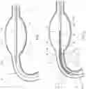 Fig. 02 - BALLOON ASSISTED ENDOLUMINAL PROSTHESIS DEPLOYMENT