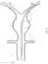Fig. 03 - BALLOON ASSISTED ENDOLUMINAL PROSTHESIS DEPLOYMENT