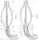 Fig. 07 - BALLOON ASSISTED ENDOLUMINAL PROSTHESIS DEPLOYMENT