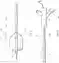 Fig. 08 - BALLOON ASSISTED ENDOLUMINAL PROSTHESIS DEPLOYMENT