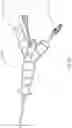 Fig. 13 - BALLOON ASSISTED ENDOLUMINAL PROSTHESIS DEPLOYMENT