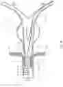 Fig. 20 - BALLOON ASSISTED ENDOLUMINAL PROSTHESIS DEPLOYMENT
