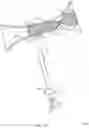 Fig. 13 - Rotatable stent delivery apparatus to cover access site