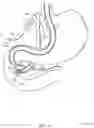 Fig. 36 - Rotatable stent delivery apparatus to cover access site