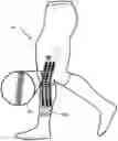 Fig. 01 - Soft braces to prevent injury to a joint or body segment