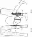 Fig. 08 - Soft braces to prevent injury to a joint or body segment