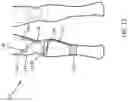 Fig. 13 - Soft braces to prevent injury to a joint or body segment