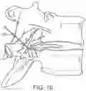 Fig. 09 - Pain management using cryogenic remodeling