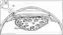 Fig. 01 - Method for eye lens removal using cavitating microbubbles