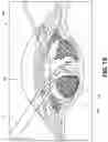 Fig. 03 - Method for eye lens removal using cavitating microbubbles