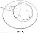Fig. 08 - Method for eye lens removal using cavitating microbubbles