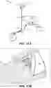 Fig. 11 - Method for eye lens removal using cavitating microbubbles