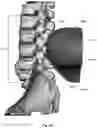 Fig. 110 - Device for releasing spinal contractures and associated methods