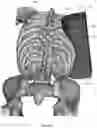 Fig. 117 - Device for releasing spinal contractures and associated methods